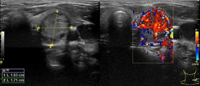 Case Report: Plummer's adenoma in Prader–Willi syndrome